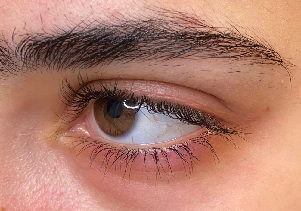 ارتخاء جفن العين المفاجئ