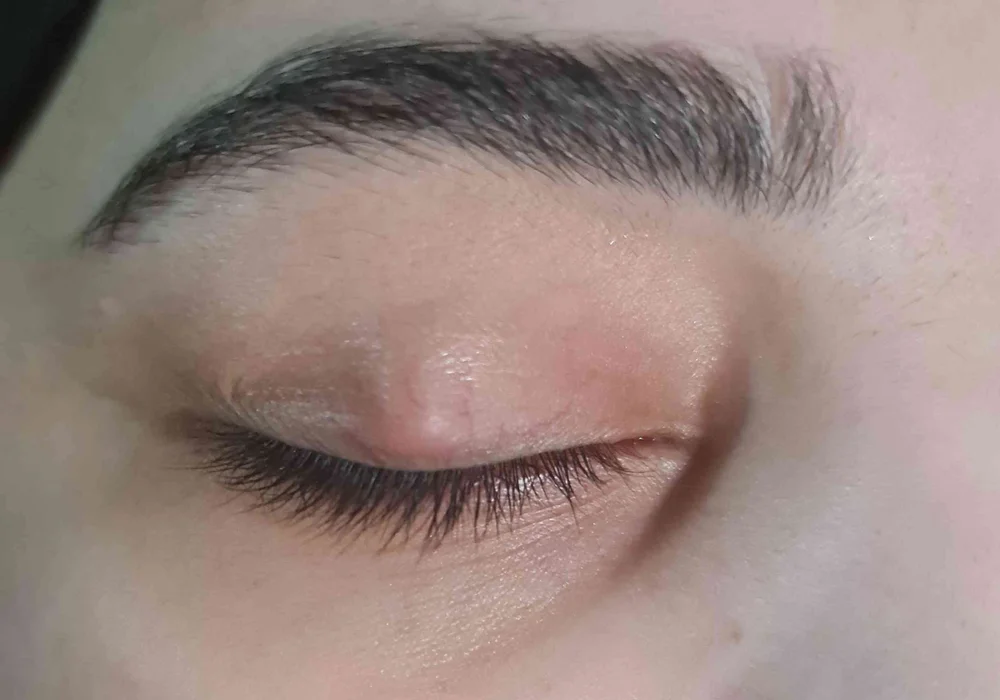 اعراض الكيس الدهني في العين