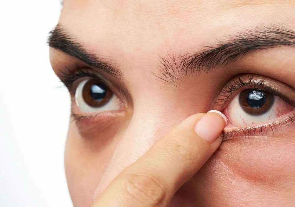 علاج الانحراف في العين