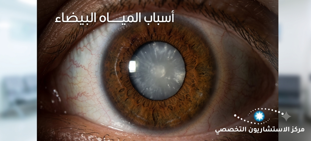 اهم واشهر أسباب المياه البيضاء